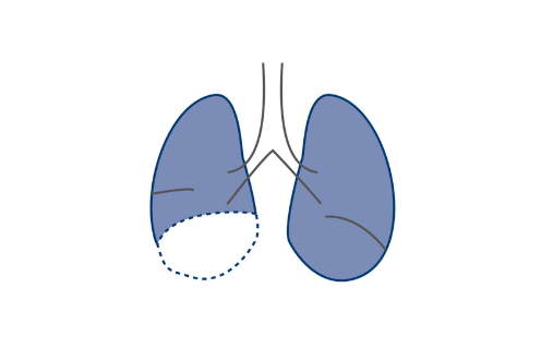 Lung cancer surgery lobectomy