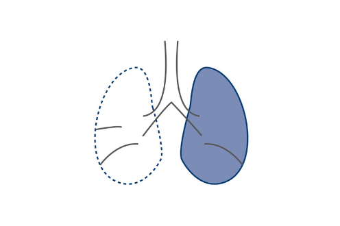 Pneumonectomy for lung cancer