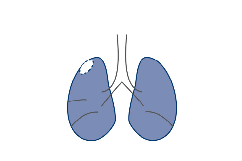 Wedge resection for lung cancer