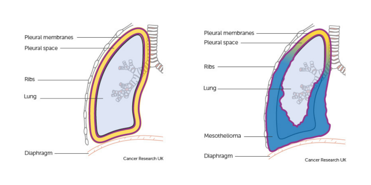 can asbestos cause lung nodules