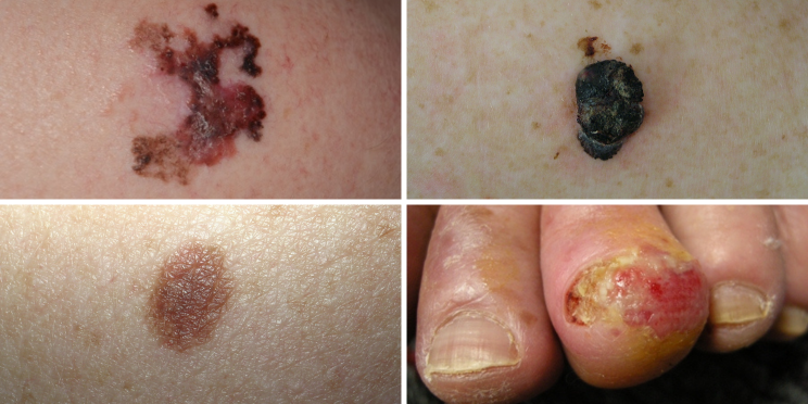 Melanoma DermNet NZ